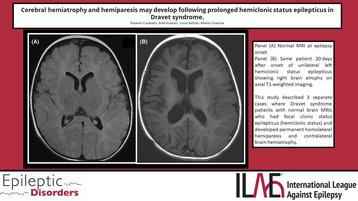 Caraballo et al. describe 3 patients with Dravet syndrome who initially had a normal brain MRI, and later developed hemiparesis & contralateral brain hemiatrophy after focal clonic status epilepticus. @JLAlcalaZermeno @RoohiKatyal @fabnascimen @SBeniczky onlinelibrary.wiley.com/doi/10.1002/ep…