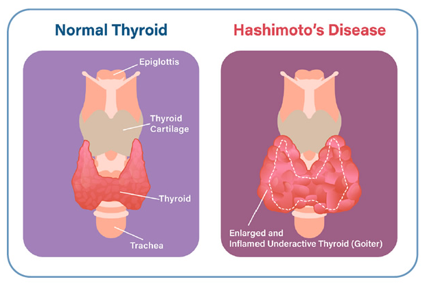 April is Hashimoto’s Awareness Month and ATA has resources for patients. ow.ly/ouSx50R6CXK #HashimotosAwarenessMonth #Thyroid #Hashimotos