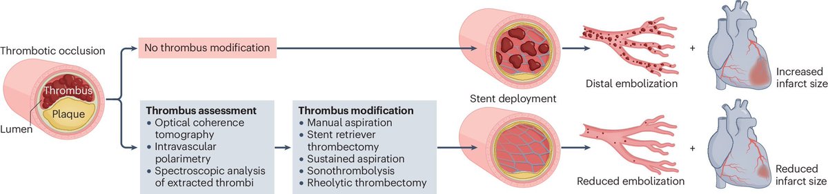 🔴 Interventional approaches to thrombus assessment and modification in patients with STEMI: rdcu.be/dDpaI 
New Clinical Outlook @NatRevCardiol #FreeToRead 

 #cardiology #CardioEd #medtwitter #meded #CardioTwitter #cardiotwiteros  #MedX #cardiovascular #MedTwitter