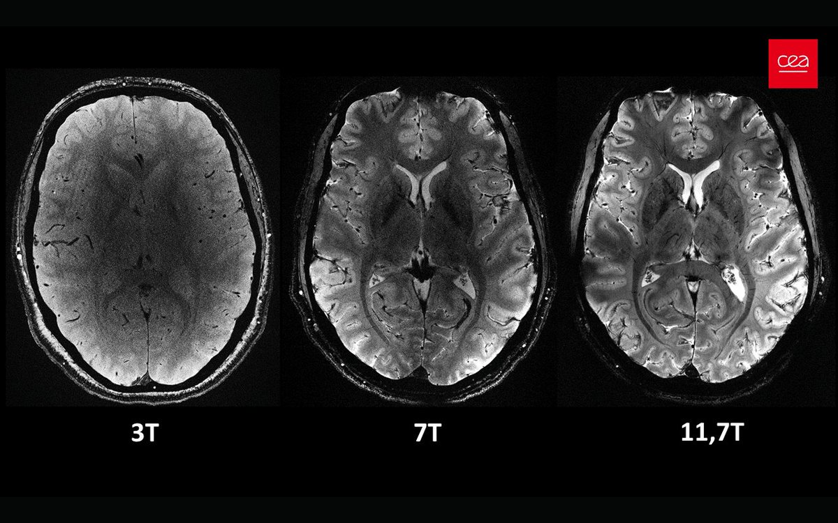 _rutvik_patel's tweet photo. After almost 20 years of R&amp;D, The CEA's Iseult project have released MRI Brain images of 11.7 Tesla MRI machine.
What a beauty!🔥
#MedX
#RadRes https://t.co/eyKaTmFIb4