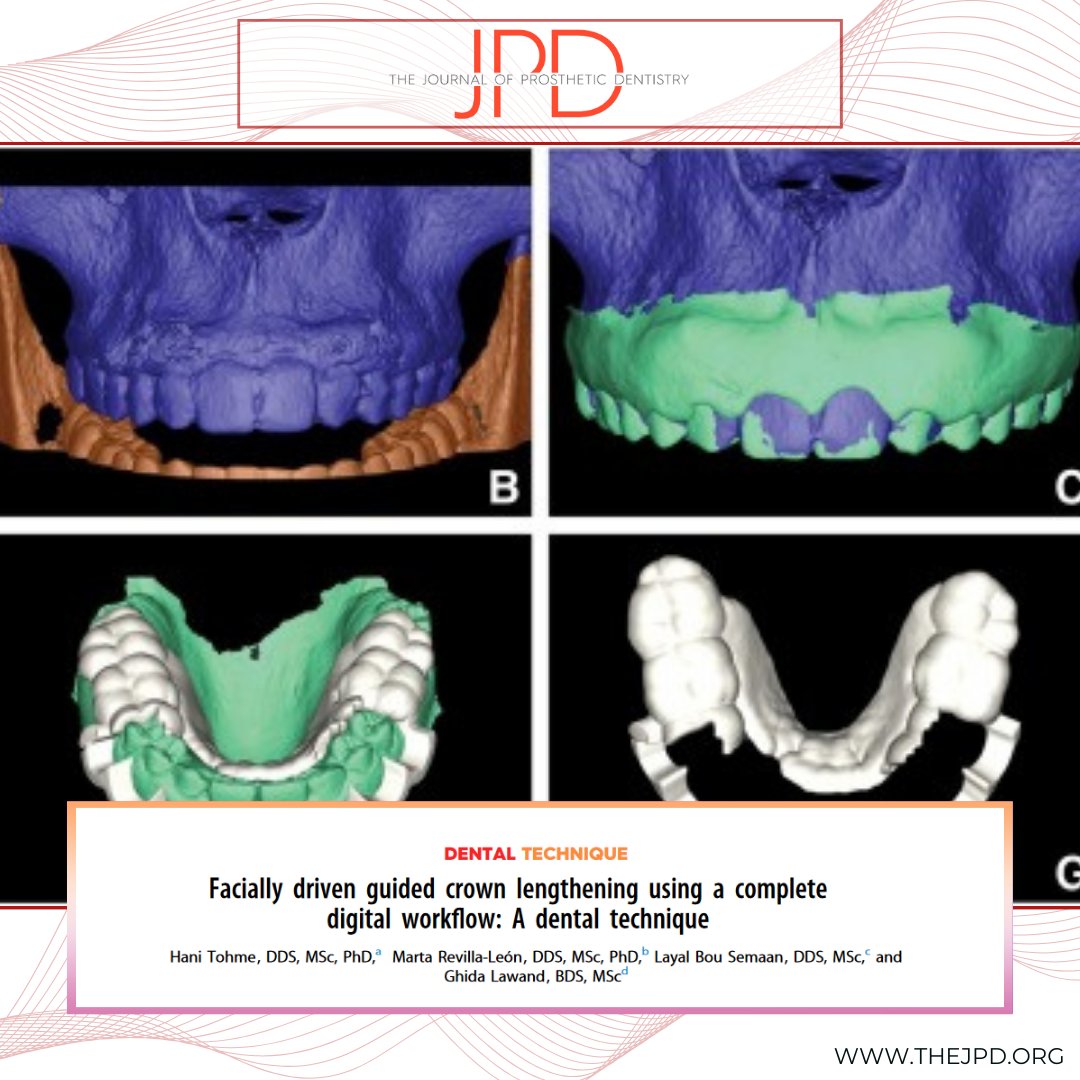 JPDentistry's tweet photo. #digitaldentistry tools like facial scanning, #intraoralscanning, and merging with #CBCT imaging can provide a predictable and fully digital means for designing a predictable #surgicalguide for #estheticcrownlengthening: https://t.co/dGRG28U3gs https://t.co/HAVODXP3z4