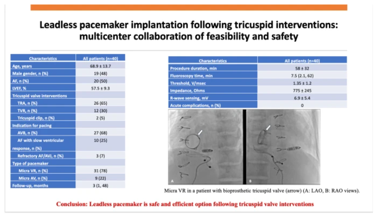 🚨Latest #FreeRead Article in @JICE_EP Leadless PM Implantation following Tricuspid Interventions: Multicenter Collaboration of Feasibility and Safety 🧐📖rdcu.be/dDpza by @enes_elvin, @PBaudinaud, @victor_waldmann,@AviSabbag, Yousef Jubeh, @clementy_ep, Arnaud…