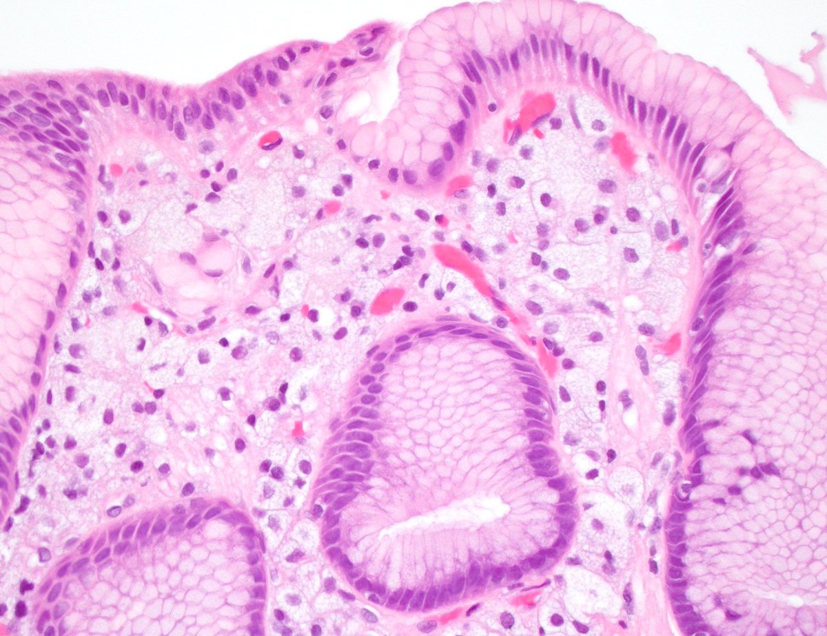 Pathoutlines's tweet photo. Image quiz! A 56-year-old man underwent an esophagogastroduodenoscopy for reflux symptoms. A biopsy was taken of a small, sessile yellow-white nodule in the stomach. The histology is depicted in the H&E image. (Cont. below)
#ImageQuiz #PathTwitter #PathologyOutlines #diagnosis https://t.co/rMavvQEIFi
