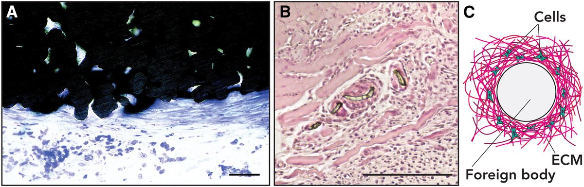 Prof @AlexanderJBoys co-authored 'Bioelectronic interfacial matching for superior implant design' in @CellRepPhysSci, which discusses the relevance of different mechanical and electronic factors. bit.ly/3xeaQM4 (Figure⬇️: fibrotic encapsulation of bioelectronic implants)