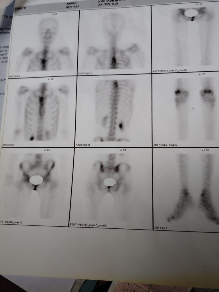 انور کیچ کے رہائشی ہیں جن کی عمر 60 ہے جو کافی سے بیماریوں سے لڑ رہے ہیں جن میں ڈورسل ورٹیبرا، گھٹنے کے گٹھیا، گردے کے مسائل اور ناقابل برداشت درد میں مبتلا ہے
انور ایک ضرورت مند گھرانے سے ہے، انہیں علاج کے لیے ہماری مدد کی ضرورت ہے 
براہ کرم شیئر کریں

PK05UNIL0109000297835222