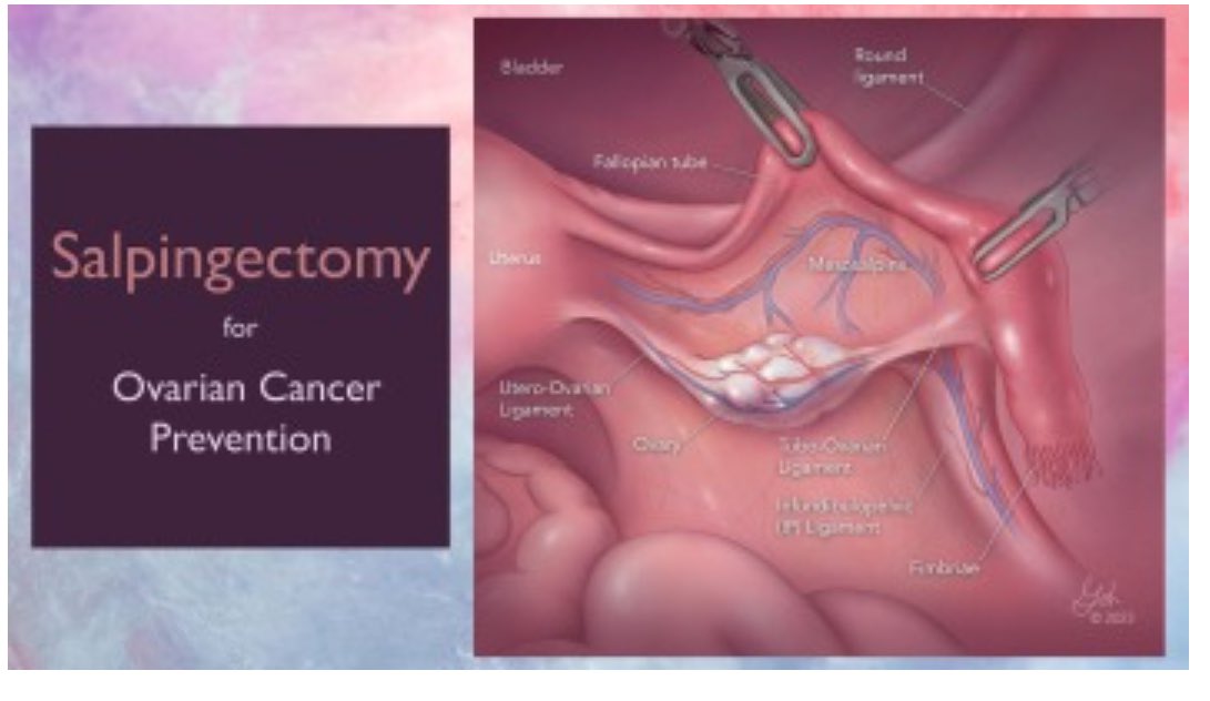 gynoncjnls's tweet photo. Salpingectomy for ovarian cancer prevention: Video education for the surgeon https://t.co/bUaDBRCo4b https://t.co/JCcHle3mj9