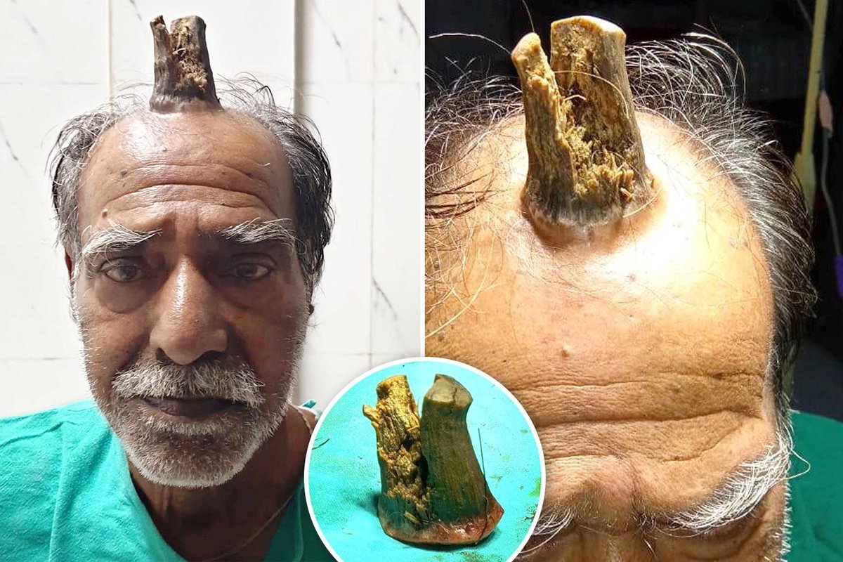 MorbidKnowledge's tweet photo. Following a head injury in 2014, an Indian man called Shyam Lal Yadav, developed a cutaneous horn, commonly referred to as a "devil's horn”. 

The growth can arise from benign, premalignant, or malignant skin lesions. 

For years, Mr. Yadav had been cutting back the growth. However, when it began to proliferate rapidly, he sought medical help.

While the precise cause of cutaneous horn is not fully understood, it is believed that cellular aging, photodamage, and subsequent dysfunction of the epithelial cells play a role in their development.
