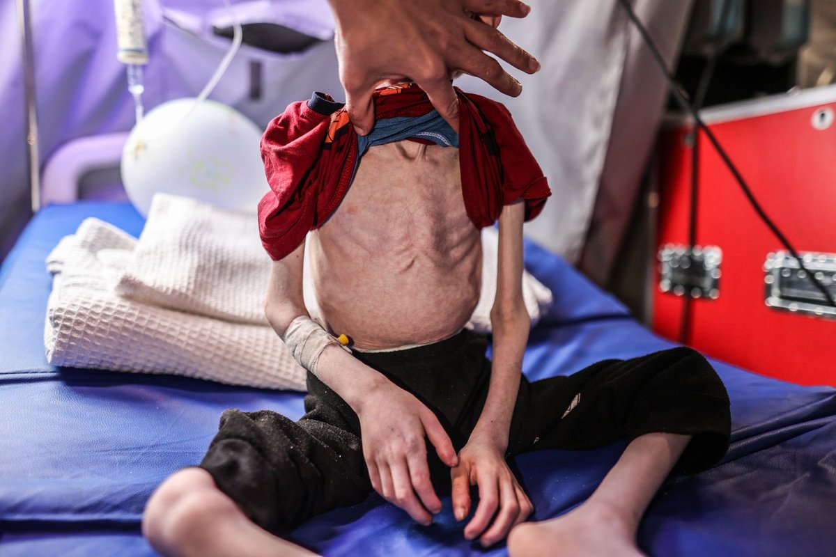 Fadi Zant, aged 9, experiencing malnutrition, receives treatment after evacuated from the northern Gaza Strip to the IMC field hospital in Rafah.