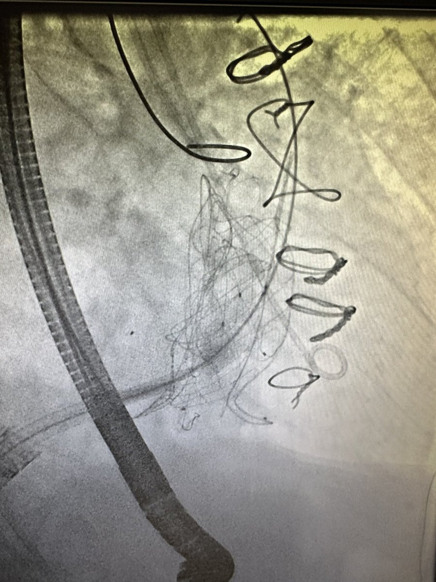1st VDyne TTVR case in the US for the VISTA EFS study! Fantastic result and patient is doing great. Many thanks to my amazing partners @bapat_savrtavr @HamidNadira @JoaoLCavalcante @kvoudris @MHIF_Heart @mryburns @AllinaHealth