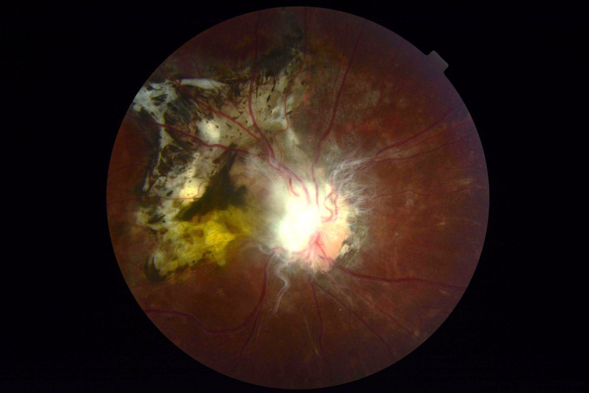 Me tocó un caso de una pcte de 18 años, sexo femenino, que acudió a la consulta por lentes,  se le hizo la refracción y decía que desde que nació nunca veía por su ojo derecho así que la pasaron al otro box para hacerle un fondo de ojo y vaya sorpresa cuando le tome la foto 🙃