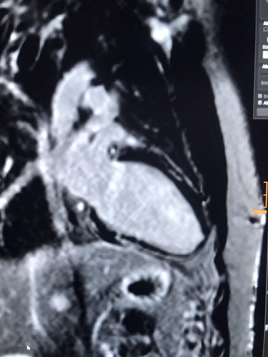 GrublerMartin's tweet photo. 29y/o male presenting with recurrent myocarditis. No sign. PMHx, PSHx or FMHx. EKG and physical exam were unremarkable. After the CMR an additional test was ordered and showed..? #whyCMR #CMR #CMRfirst #cardiomyopathies #FOAMed https://t.co/RS4Ma96IV3