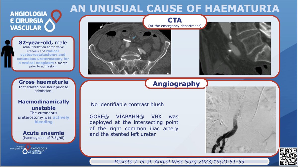 Find the treatment option chosen by Peixoto et al here: acvjournal.com/index.php/acv/…

#ESVS
#SPACV
#Vascularsurgery
#Ureteroarterialfistula