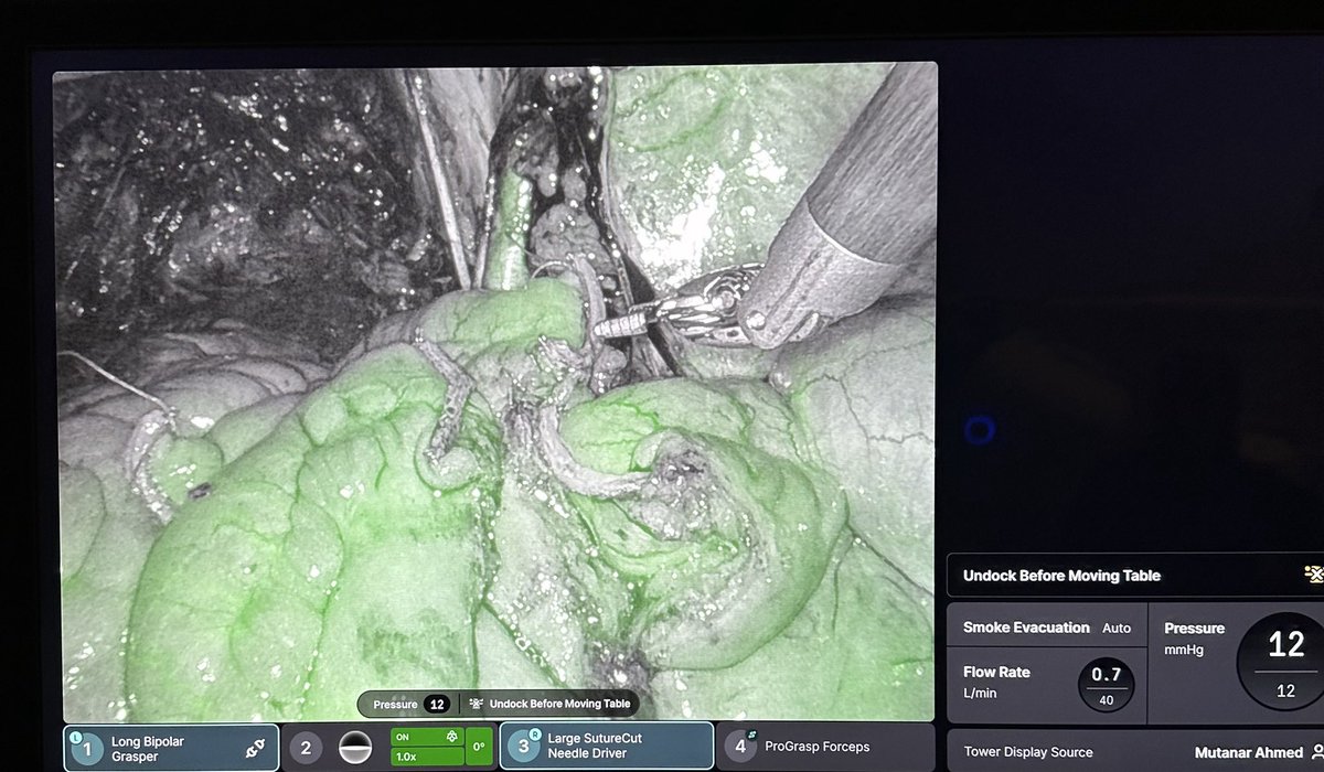 Mutahar Ahmed (@roboticsurology) on Twitter photo First day on the <a href="/IntuitiveSurg/">Intuitive</a> dV5. Many internal features..Auto smoke evac and tip warmer is great addition.
Entire cystectomy and intracorporeal diversion without cleaning camera
Real test comes tomorrow <a href="/mdstifelman/">Michael Stifelman</a> <a href="/HMHNewJersey/">Hackensack Meridian</a> <a href="/HUMCUrology/">HackensackUMC Department of Urology</a> First day on the <a href="/IntuitiveSurg/">Intuitive</a> dV5. Many internal features..Auto smoke evac and tip warmer is great addition.
Entire cystectomy and intracorporeal diversion without cleaning camera
Real test comes tomorrow <a href="/mdstifelman/">Michael Stifelman</a> <a href="/HMHNewJersey/">Hackensack Meridian</a> <a href="/HUMCUrology/">HackensackUMC Department of Urology</a>