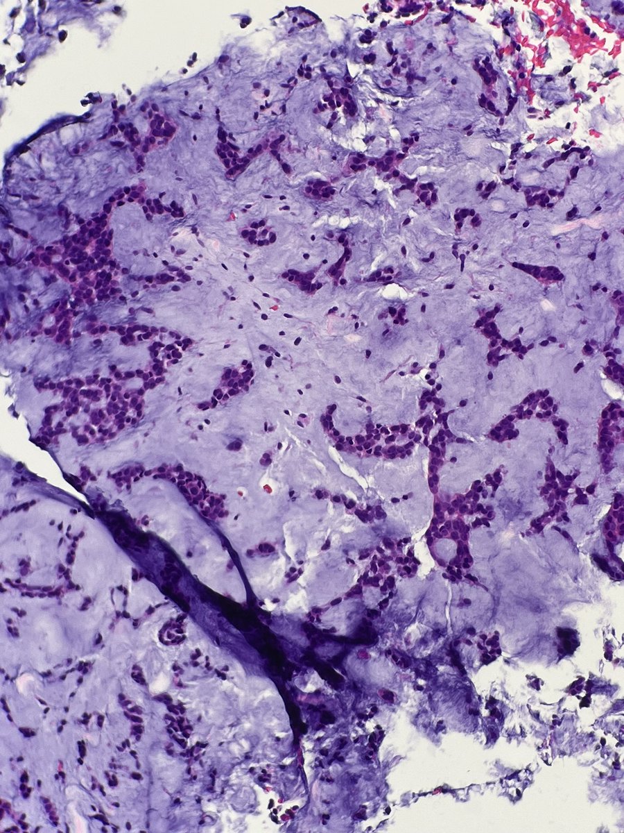 Biopsy, One small tissue fragment from the ENT When you see this, it’s a slam dunk 🏀 or is it? #MarchMadness #PathX #PathTwitter Quiz 🧵#pathquiz