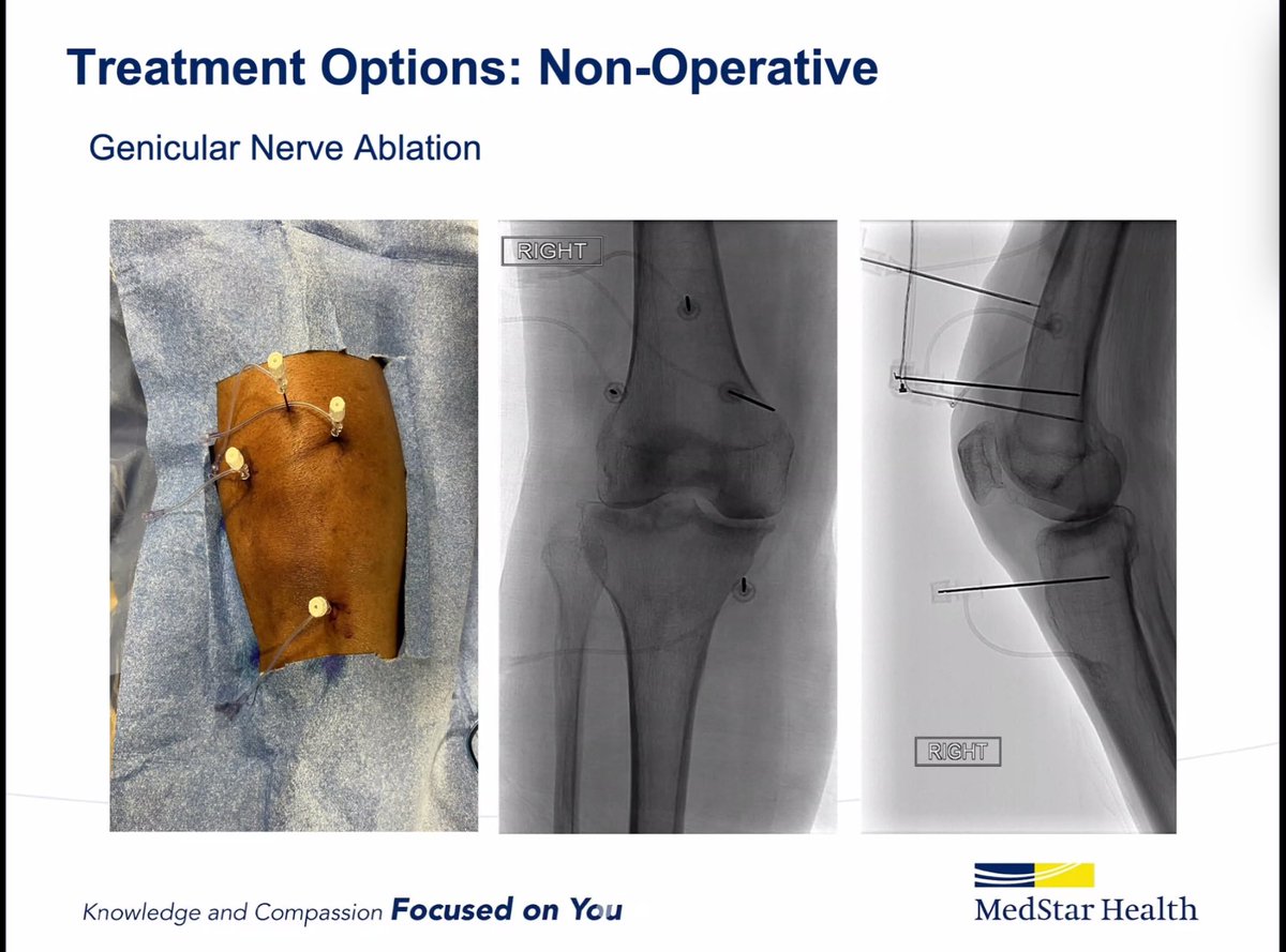 Dr. John Smirniotopoulos, discusses the benefits of Genicular nerve ablation for patients with Osteoarthritis