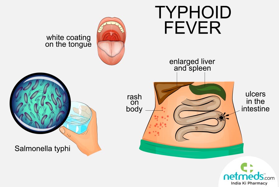 chilli_milli5's tweet photo. Typhoid fever is a bacterial infection that can spread throughout the body, affecting many organs. Without prompt treatment, it can cause serious complications and can be fatal.
#Typhoid_Fever #MedicalStudent #Medical_Knowledge https://t.co/i1NHLC1eFa