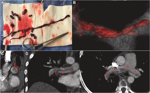 Rozenbaum_Z's tweet photo. Revisiting Systemic Thrombolysis in Acute Pulmonary Embolism | JACC: Advances https://t.co/Ip2DasMxRX 

@JACCJournals #JACCAdvances #CardioTwitter #ACCIC #JACCAdv @ACCinTouch @journal_chest https://t.co/gx1MRVhOo0