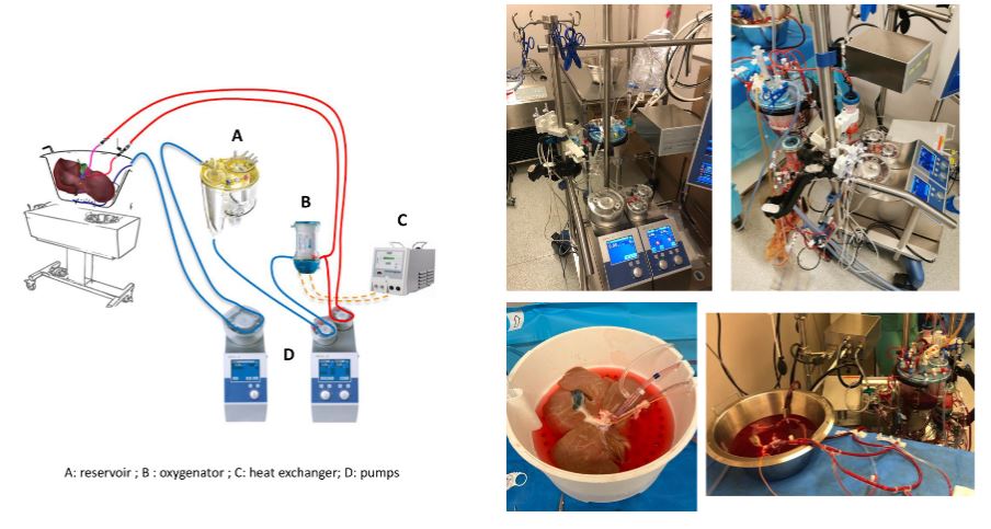 #Preclinical validation of a customized circuit for #ExSitu uninterrupted cold-to-warm prolonged #Perfusion of the #Liver 👉tinyurl.com/s8yv6v5n @Sorbonne_Univ_🇫🇷| @GoumardC #Normothermic