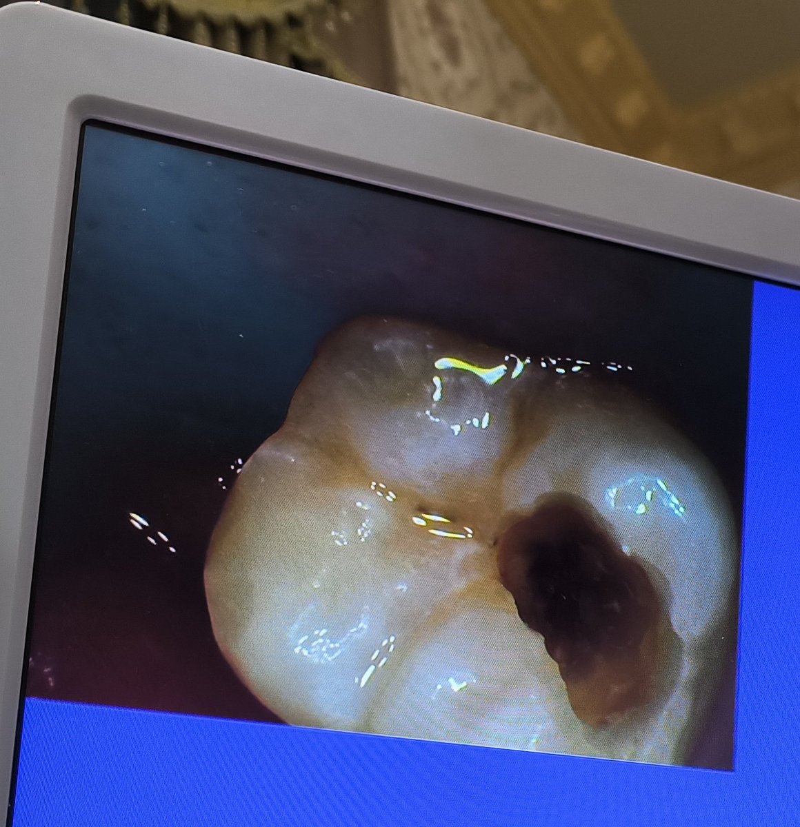 philosopiaurus's tweet image. Untung infeksi nya blm ampe akar gigi oiii. Reminder buat all, kalo ada item² di gigi walopun gigi lu ga sakit mending langsung periksa.