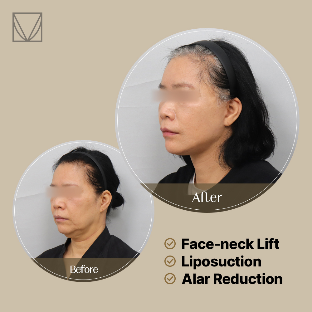 ❤️Magical result!❤️#facelift 

#facelift #necklift #liposuction #antiwrinkle #antiwrinkletreatment #alarplasty #smas #skintightening #doublechin #plasticsurgery #aestheticsurgery #boardcertifiedplasticsurgeon #koreaplasticsurgery #Koreabeauty #droopy #vlifplasticsurgery