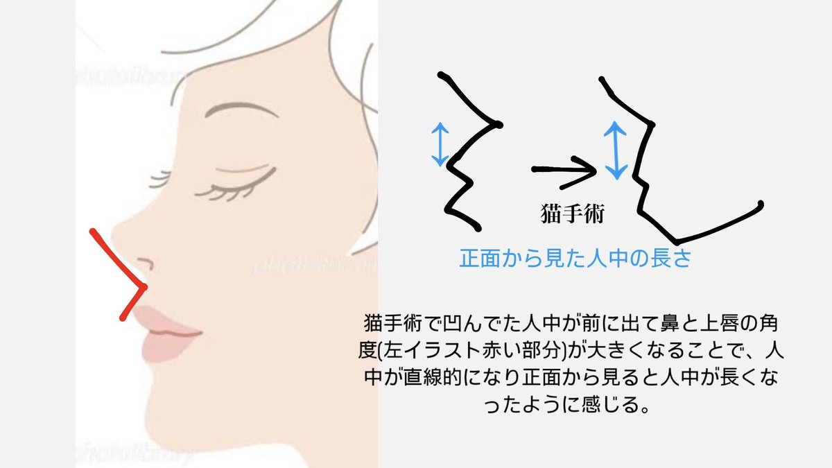 tooka1414's tweet photo. 【鼻整形と一緒に猫手術検討してる方へ】猫手術の後に人中の長さが長く感じる可能性あります。
人中自体は元々長かったんだけど凹んでたことで長さが気になってなかったタイプの人(具体的には赤色の角度が小さい人)は、猫手術によってより長く見えるようになります。体験談です🥲 https://t.co/cDcCzeSprP