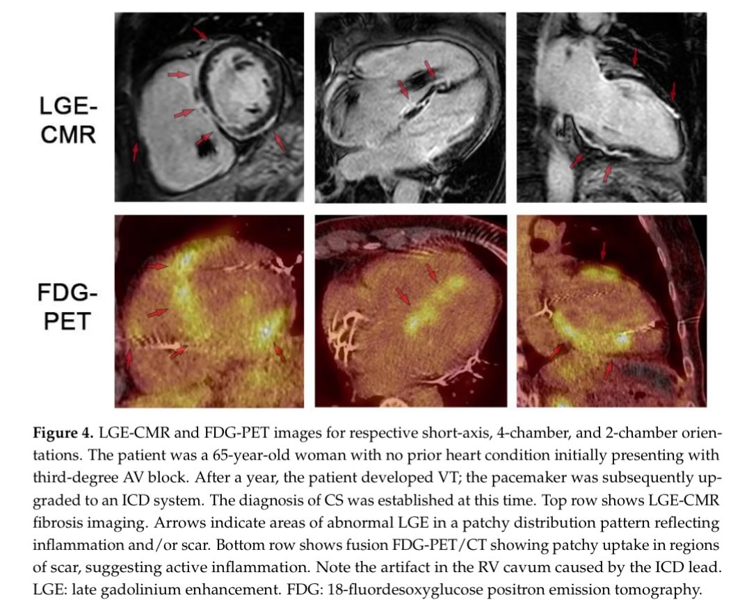 Review Cardiac Sarcoidosis—Diagnostic and Therapeutic Challenges doi.org/10.3390/jcm130… #echofirst #CardioEd #CardioTwitter