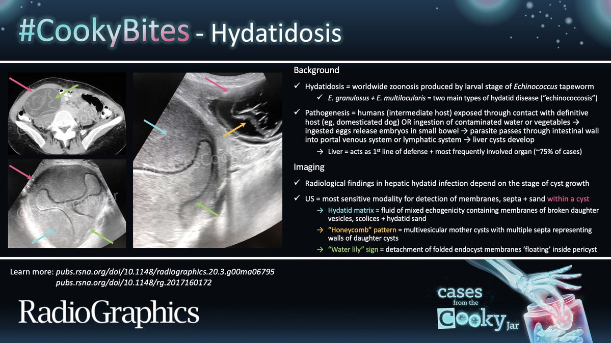 Answer: Hydatidosis Learn more: 🔗pubs.rsna.org/doi/10.1148/ra… 🔗pubs.rsna.org/doi/10.1148/rg… #CookyBites #157 #RGphx @cookyscan1 @RadioGraphics