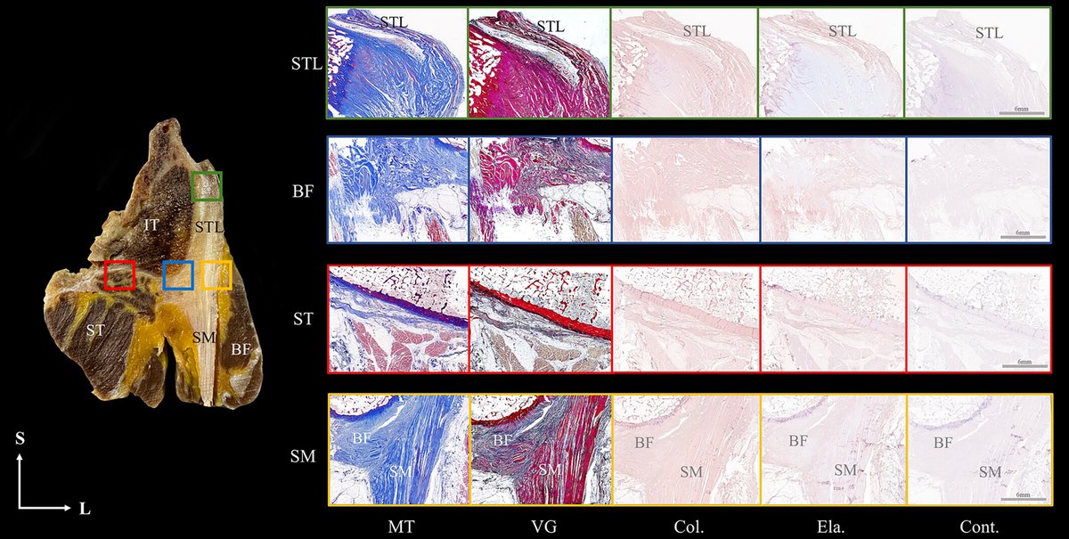 Anatomical study of the sacrotuberous ligament and the hamstring muscles FREE PDF onlinelibrary.wiley.com/doi/epdf/10.10…