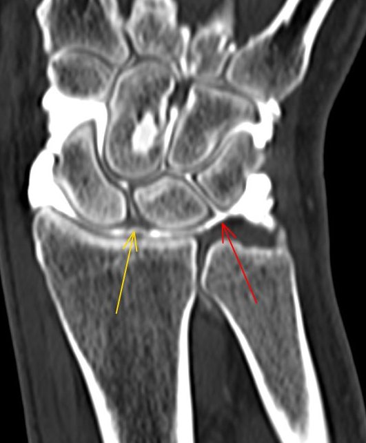 3/4/2024. 🔴Arrow is pointing to a relevant finding in this 42-year-old male following wrist trauma and pain. What's the name? 🟡 Arrow highlights another important structure in #wrist proximal row carpal stability. Arthro-#CT and #MRI have been performed. Results will come.