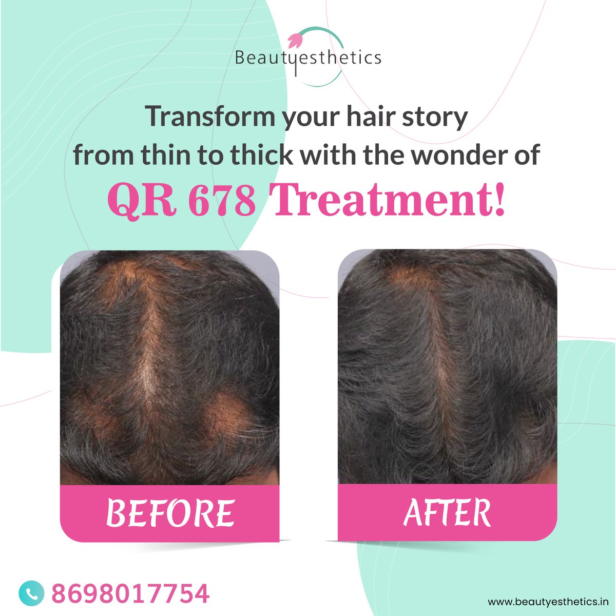 Dreaming of thicker, fuller hair? Let's turn that dream into a reality with QR 678. It's not just a treatment; it's a new beginning for your hair. Are you ready?

#QR678 #hairfall #antihairfall #hairgrowth #pune #beaityesthetics #ExploreMore
