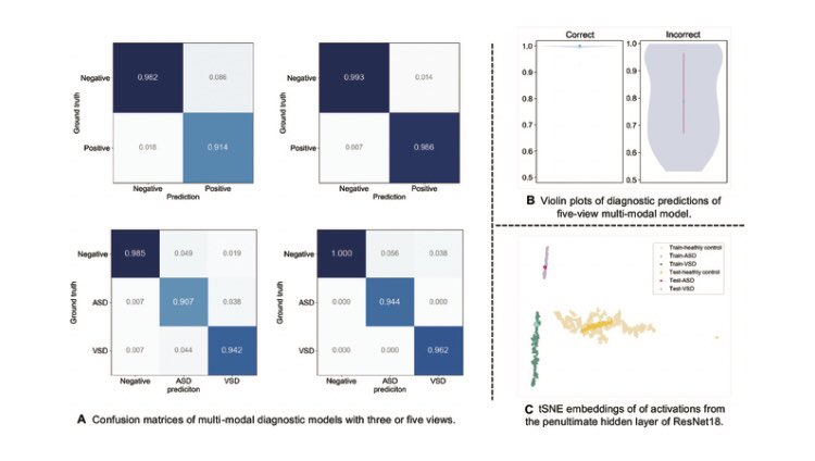 Development and Validation of a Deep-Learning Network for Detecting Congenital Heart Disease from Multi-View Multi-Modal Transthoracic Echocardiograms. Click the link below to read this free, open access article. @SPJournals doi.org/10.34133/resea…