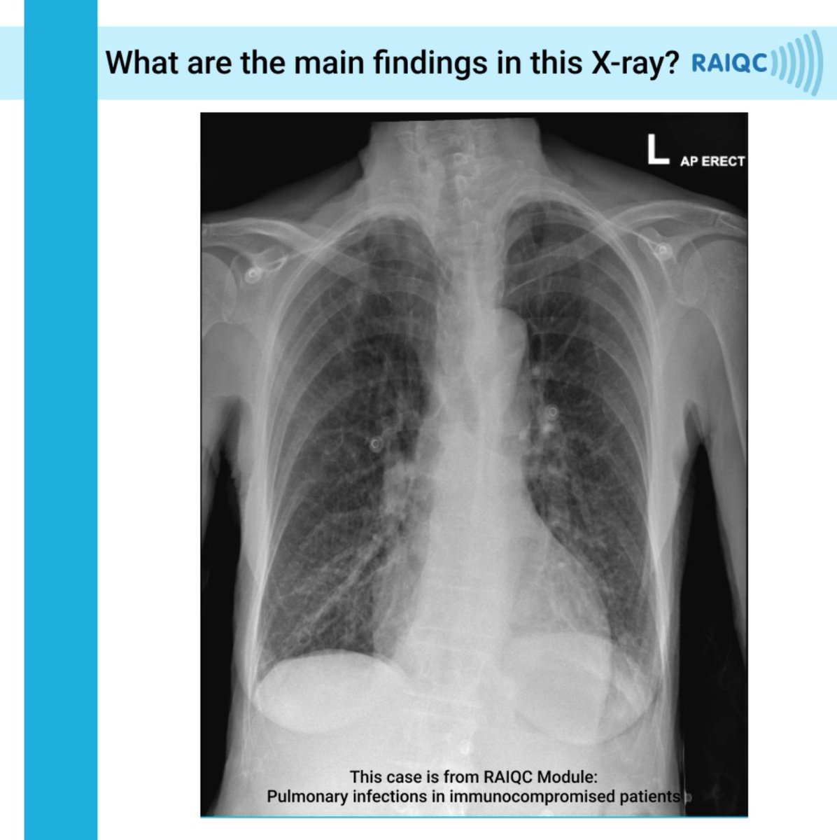What're the findings on this CXR?
What's the diagnosis? 
We’ll post the answer in 24 hours!

For more cases like this, check out our educational package at raiqc.com

#RAIQC #radiology #radiologyeducation #radiologist #radiographer #onlineplatform #medicalimaging
