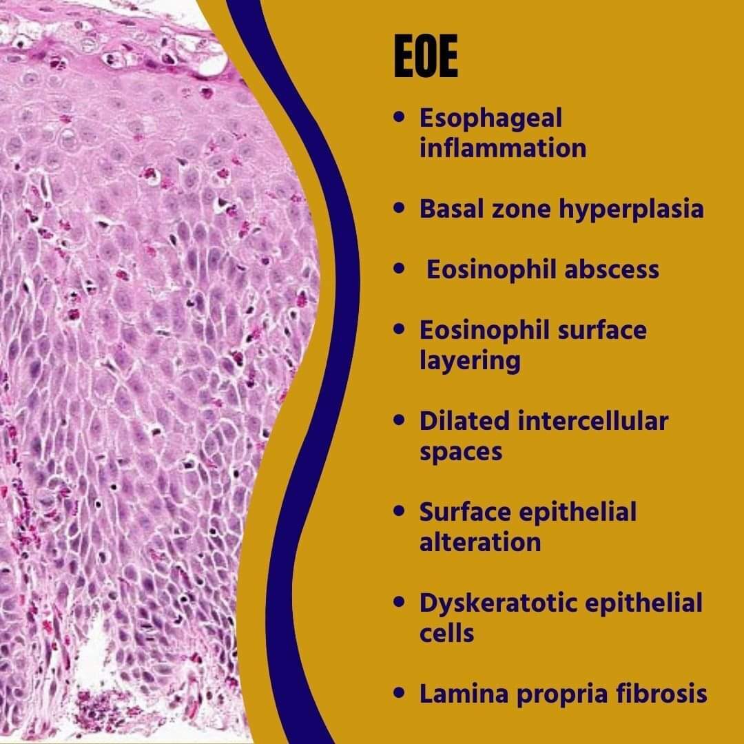 Your gastroenterologist asks about the EoE monitoring score. There is no LP in the sample to evaluate fibrosis. Which of these other items used for grading and staging can predict the presence of Lamina propria fibrosis? #pathplus #pathology #pathologist