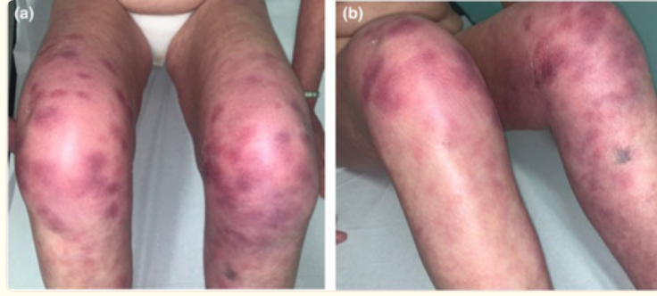 mRNAdeaths's tweet photo. 52‐year‐old woman presenting with purpuric lesions on the knees and lower third of her thighs.
The lesions had appeared about 7–10 days after the 1st dose of the #Moderna #mRNA vaccine.
https://t.co/aobUYxTaMG https://t.co/Mo56ujcW0M