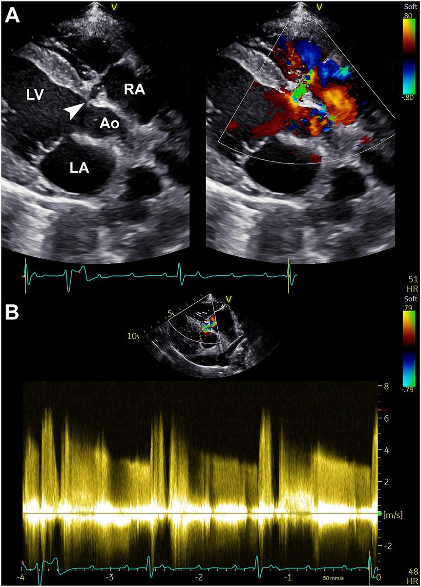 The Gerbode defect is a unique presentation of a ventricular septal defect that results in a left ventricle to right atrium shunt. Untreated, Gerbode defects can lead to complications including heart failure, infective endocarditis and death. bit.ly/43I0pfQ @CASEfromASE