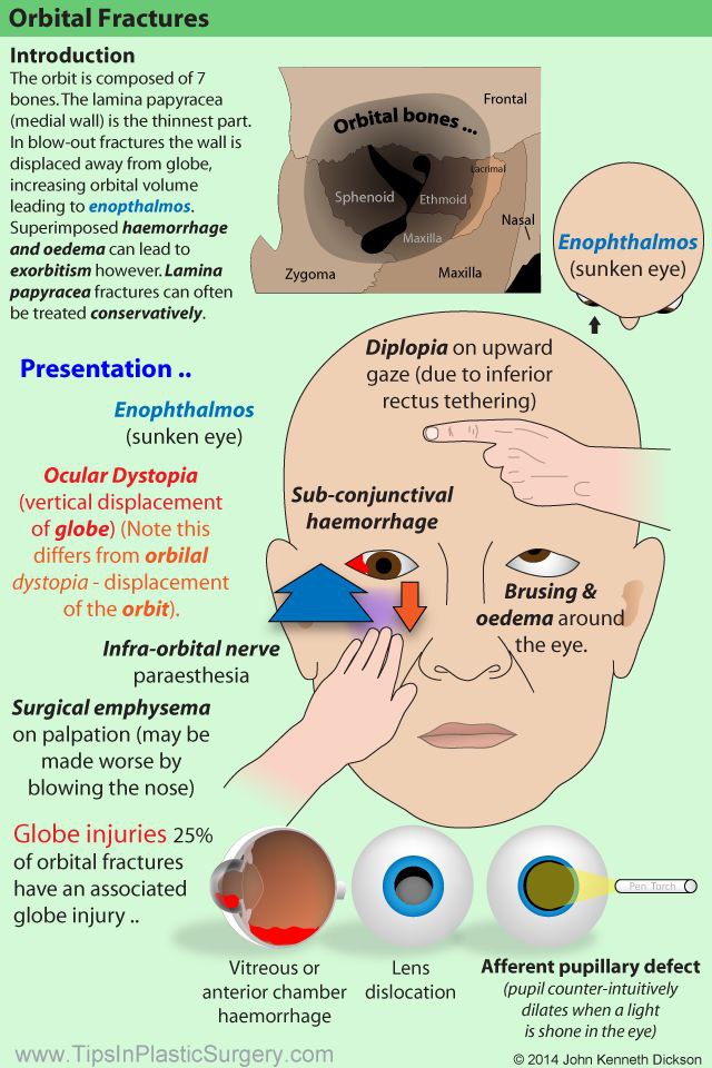 Beautiful infographics about ORBITAL FRACTURE from TipsInPlastucSurgery👍Orbital bones are thin, with varying shapes, prone to Fx(s) from relatively minor trauma.Also,orbit is close to vital intracranial structures. So it's imperative to know its anatomy well.
see the comment too