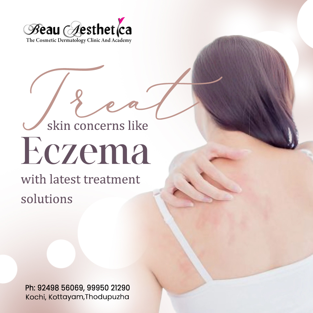 Eczema, a common skin condition characterized by redness, itching, and inflammation. Take the first step towards clearer, healthier skin by scheduling a consultation with our expert team! For appointment: 92498 56069 / 99950 21290 #eczema #eczemarelief #skintreatment #kochi