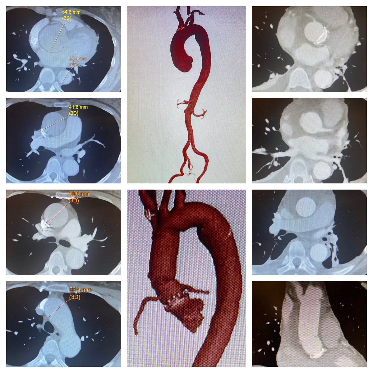 Quinquagenarian (BSA 1.6) with severe aortic insufficiency (tricuspid aortic valve) and LV dilation, associated with root + ascending + proximal transverse arch #aorticaneurysm, treated with aortic root replacement with a 23 mm mechanical composite valve graft with reimplantation…