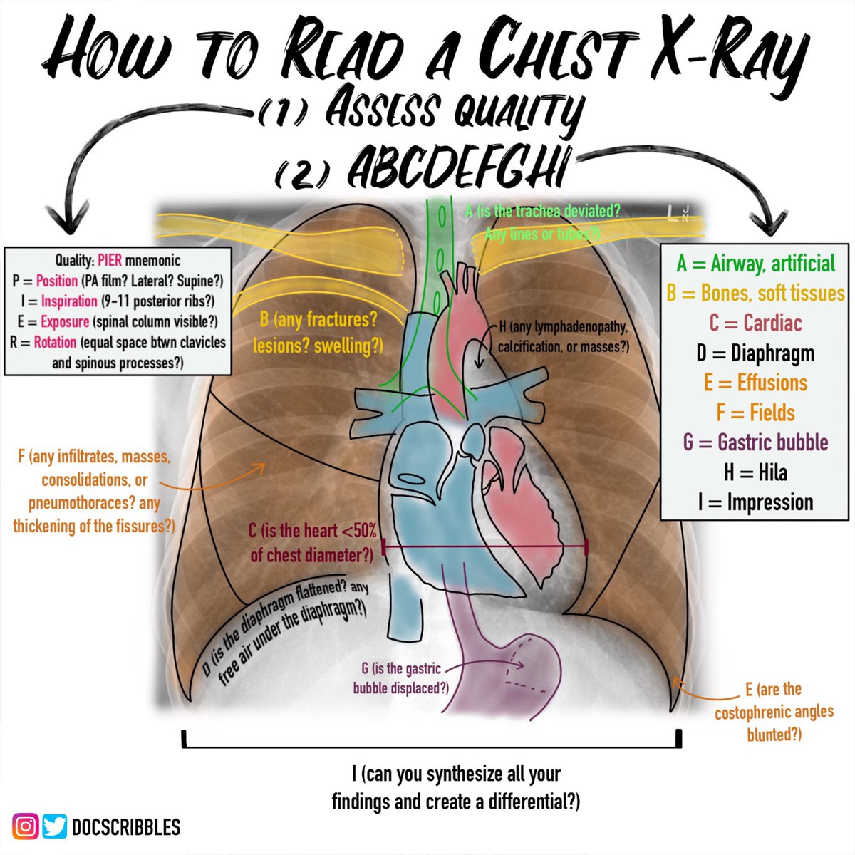 How to read a chest X-ray? <a href="/DocScribbles/">Cathy Cichon</a> #MedX