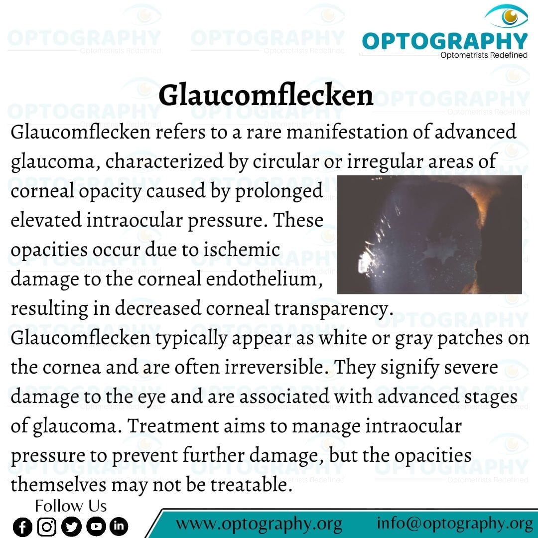Glaucomflecken are white or gray patches on the cornea caused by prolonged elevated intraocular pressure, indicating advanced damage in glaucoma. #GlaucomaAwareness #EyeHealth #Ophthalmology #Glaucomflecken #CornealOpacity #IntraocularPressure #EyeConditions #Optometry