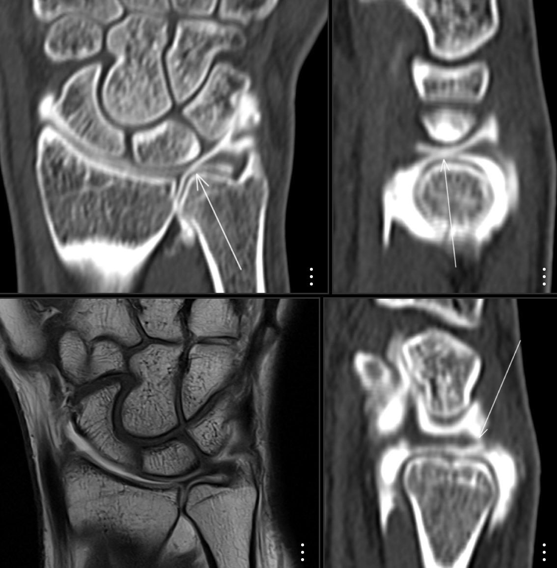 For all of you who ask us why we perform CT arthrography in addition to MR arthrography studies, I believe that a picture is worth a thousand words. Central and dorsal fibrocapsular TFCC tears demonstrated by CT, look for the central tear on the MR image, same patient same day.