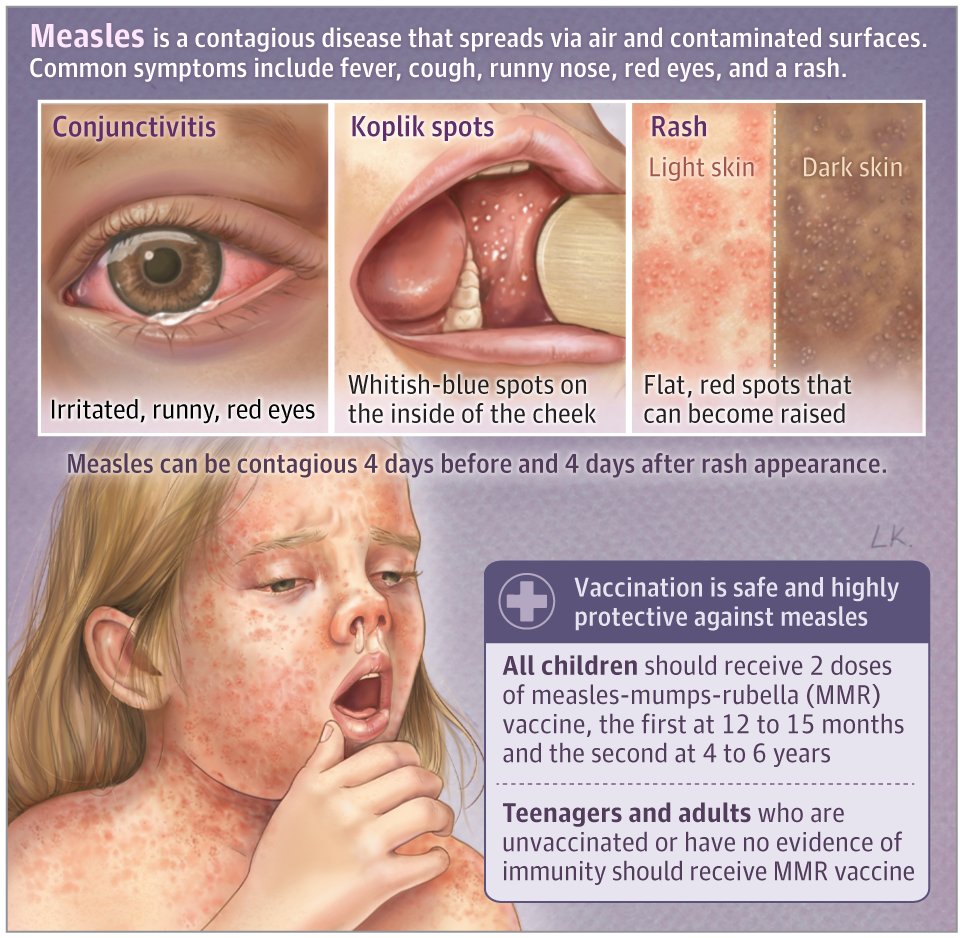 Measles cases are spreading in the US. This JAMA Patient Page explains measles diagnosis, potential complications, and information about treatment and prevention. Click the link to learn more. ja.ma/43Hz7X2