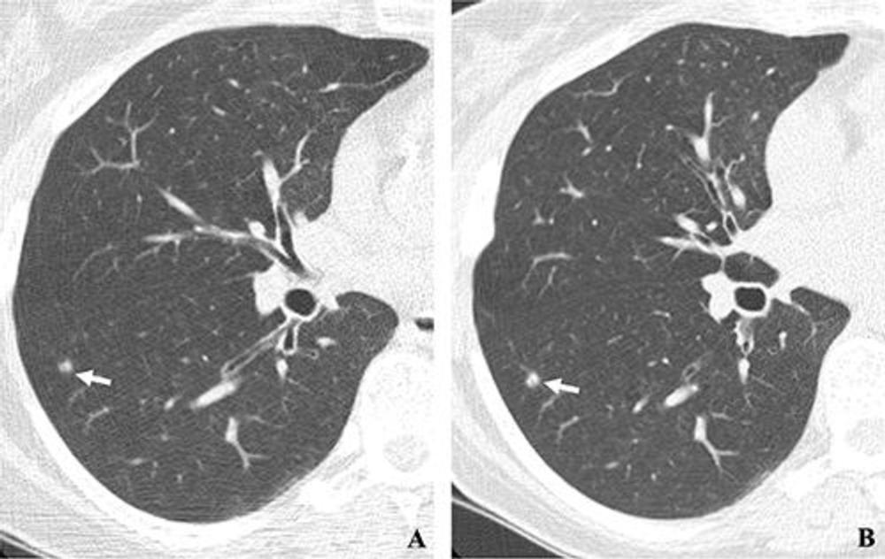 Mount Sinai Study Calls for Lung Cancer Screening Changes in Patients With Comorbidities 🫁 Learn more ➡️ bit.ly/3J1pJnN @MountSinaiNYC @AnnFamMed #LungCancer #RadEd #RadNews #Radiology #LungCancerScreening