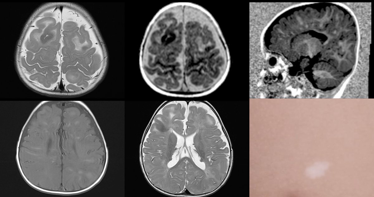 Classic case. #Neurorad #radiology #epilepsy #radres #MedEd #Medicine #Neurology #neurosurgery #peds #radres #futureradres