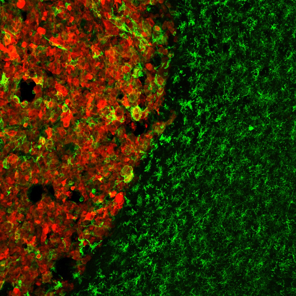 UniWarszawski's tweet photo. Biolożki z #UW dokonały przełomowych odkryć podczas badań nad glejakiem wielopostaciowym. Opisano je na łamach #EMBOReports oraz „Cell Death and Disease”. Badania otwierają nowe perspektywy w leczeniu nowotworów.
🔗https://t.co/DCUxJNo4XJ https://t.co/srGhVwYx9o