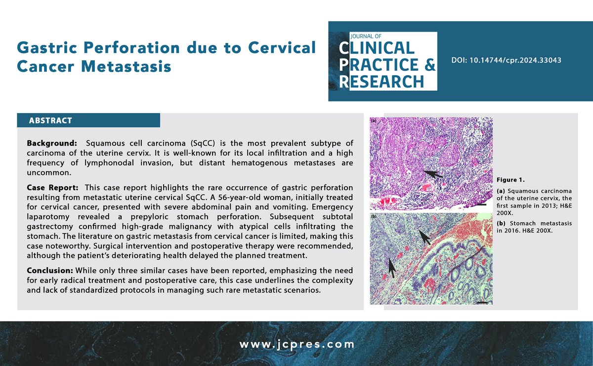 Gastric Perforation due to Cervical Cancer Metastasis
jcpres.com/storage/upload…

#FOAMed #FOAM #MedTwitter #MedEducation #medicaljournal #JClinPractRes #metastasis #carcinoma #pepticulcer