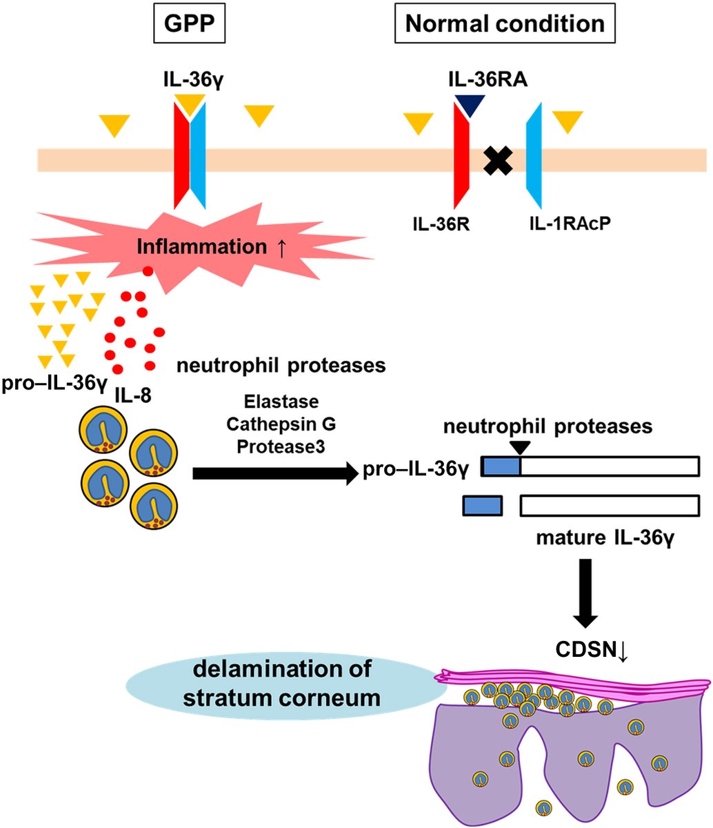 Mature interleukin-36γ induces stratum corneum exfoliation in generalized pustular psoriasis by suppressing corneodesmosin doi.org/10.1016/j.jid.… #JIDJournal #dermscience #dermtwitter