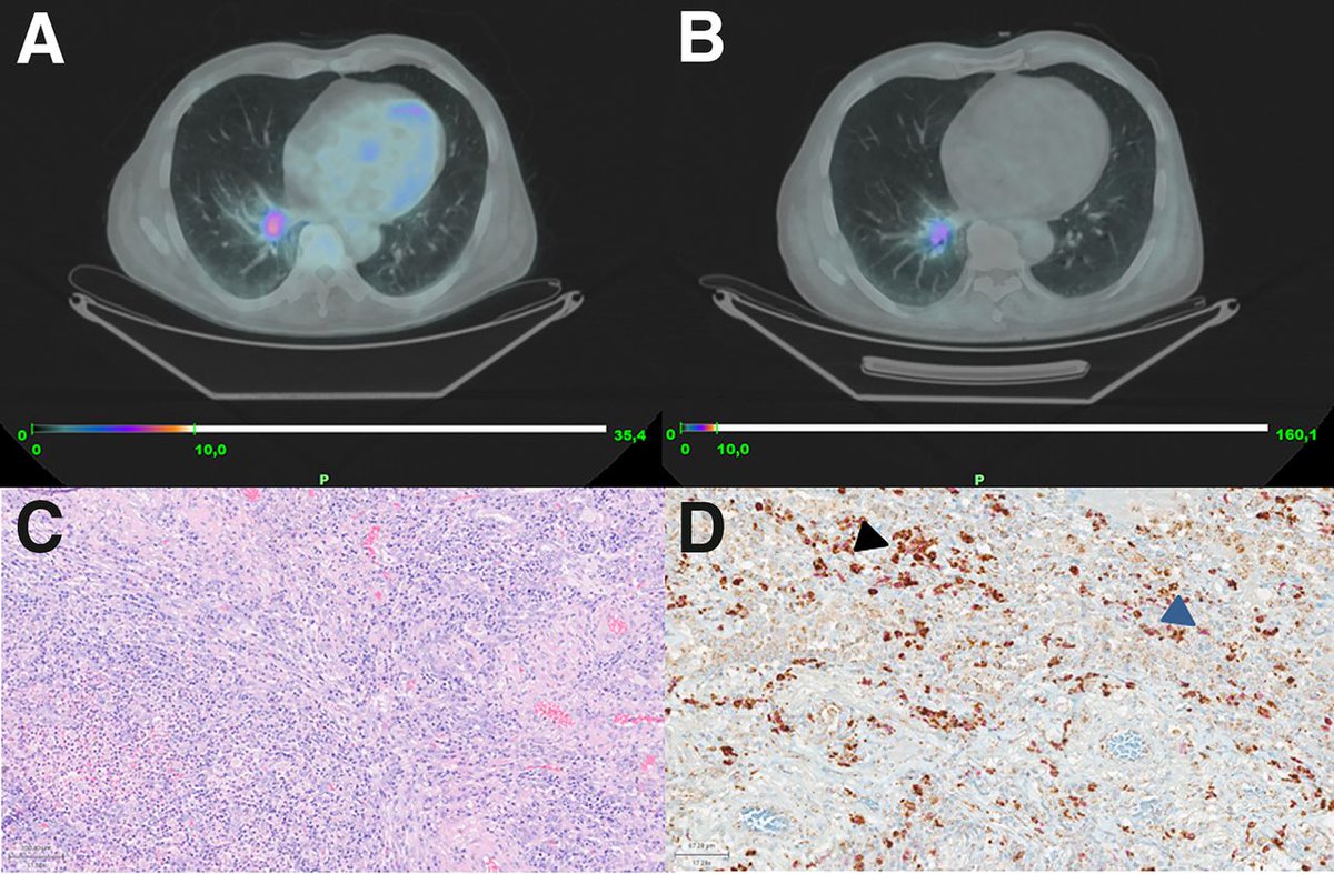 Case Report: Pulmonary actinomyces infection mimics lung cancer on ⁶⁸Ga-FAPI PET/CT. ow.ly/mrHR50QUoES #NuclearMedicine #PETscan #MedicalImaging @stefanofanti4