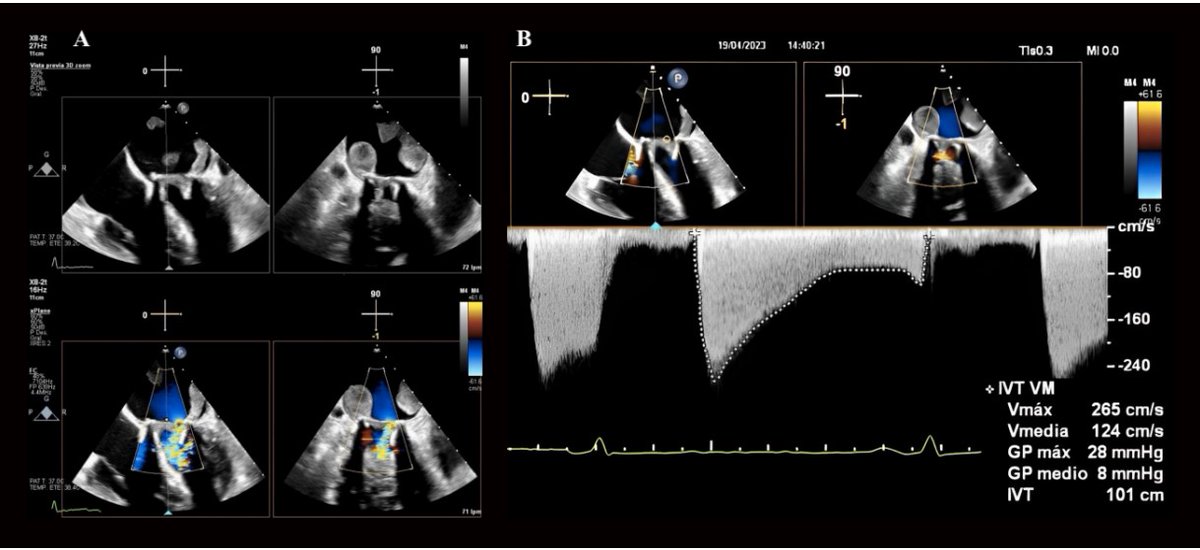Unraveling the complexities of prosthetic valve thrombosis in a Sarcoidosis patient undergoing Nintedanib treatment. Dive into this intriguing case. <a href="/germanag96/">Germán</a> <a href="/ACorazonHUVV/">Área del Corazón del HUVV de Málaga</a> #AHAJournals <a href="/JiwonKimMD/">Jiwon Kim, MD</a> <a href="/kaznegishi/">Kaz Negishi@Cardiologist/ Heart Mafia</a> 
doi.org/10.1161/CIRCIM…