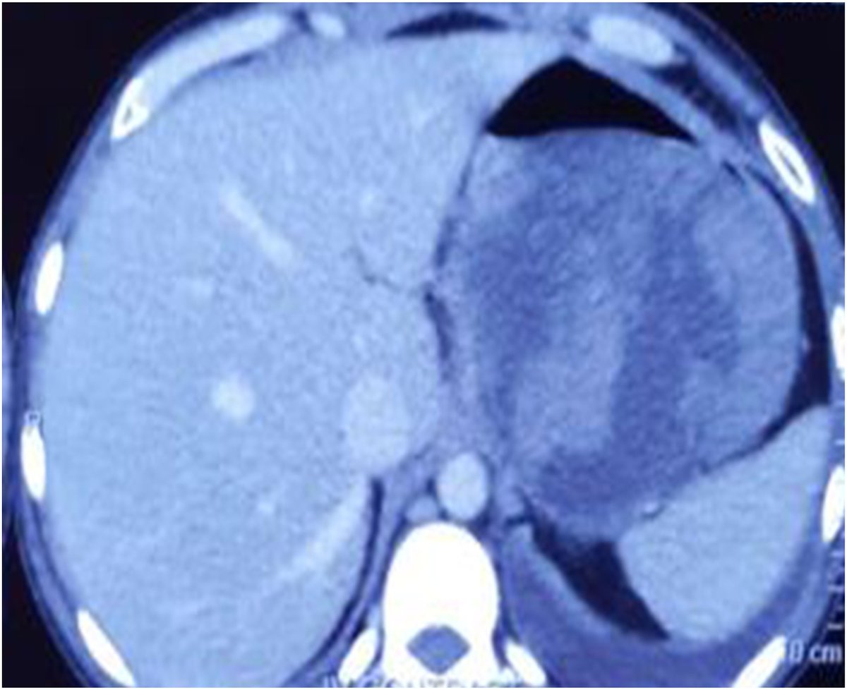 In iNNOVATIONS: iMAGES in the latest issue of iGIE: Kishalaya et al examine 'Histoacryl glue injection in walled-off necrosis impression on gastric wall mistaken as gastric varix: an unintended adverse event having therapeutic benefit.' spkl.io/601540w3W @iGIEjournal